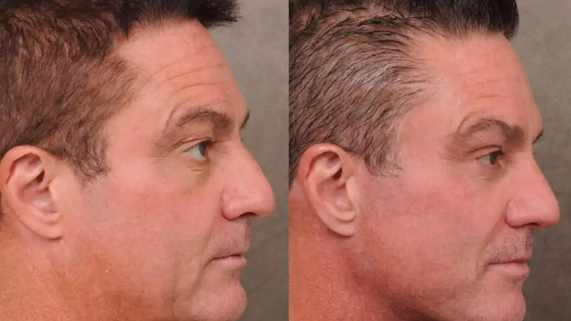 美国科技男也爱上“微整容”