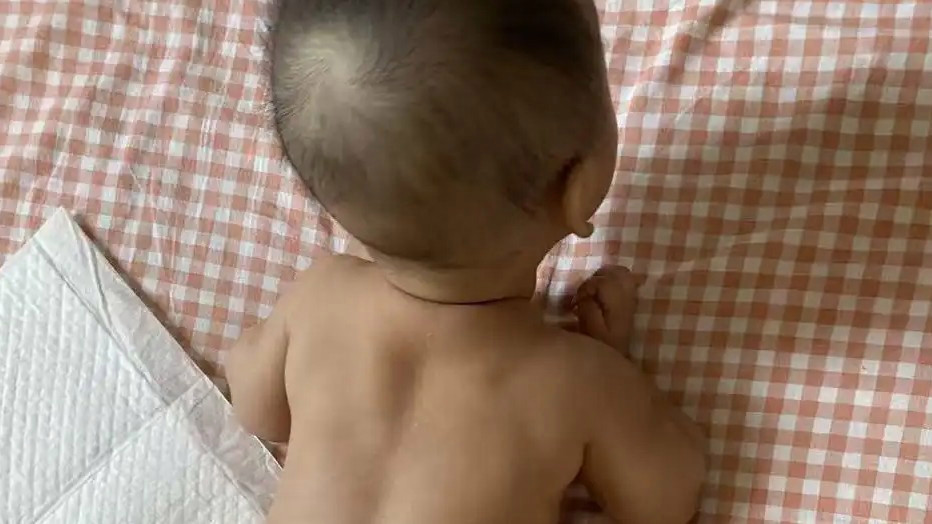 女婴半岁确诊脊柱裂大排畸报告正常